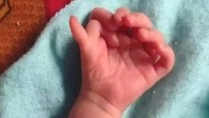 Un bébé né avec 26 doigts et orteils