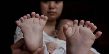 Un bébé né avec 26 doigts et orteils
