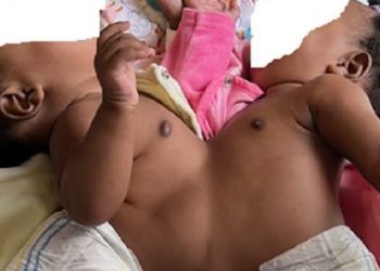 Séparation réussie de jumelles siamoises